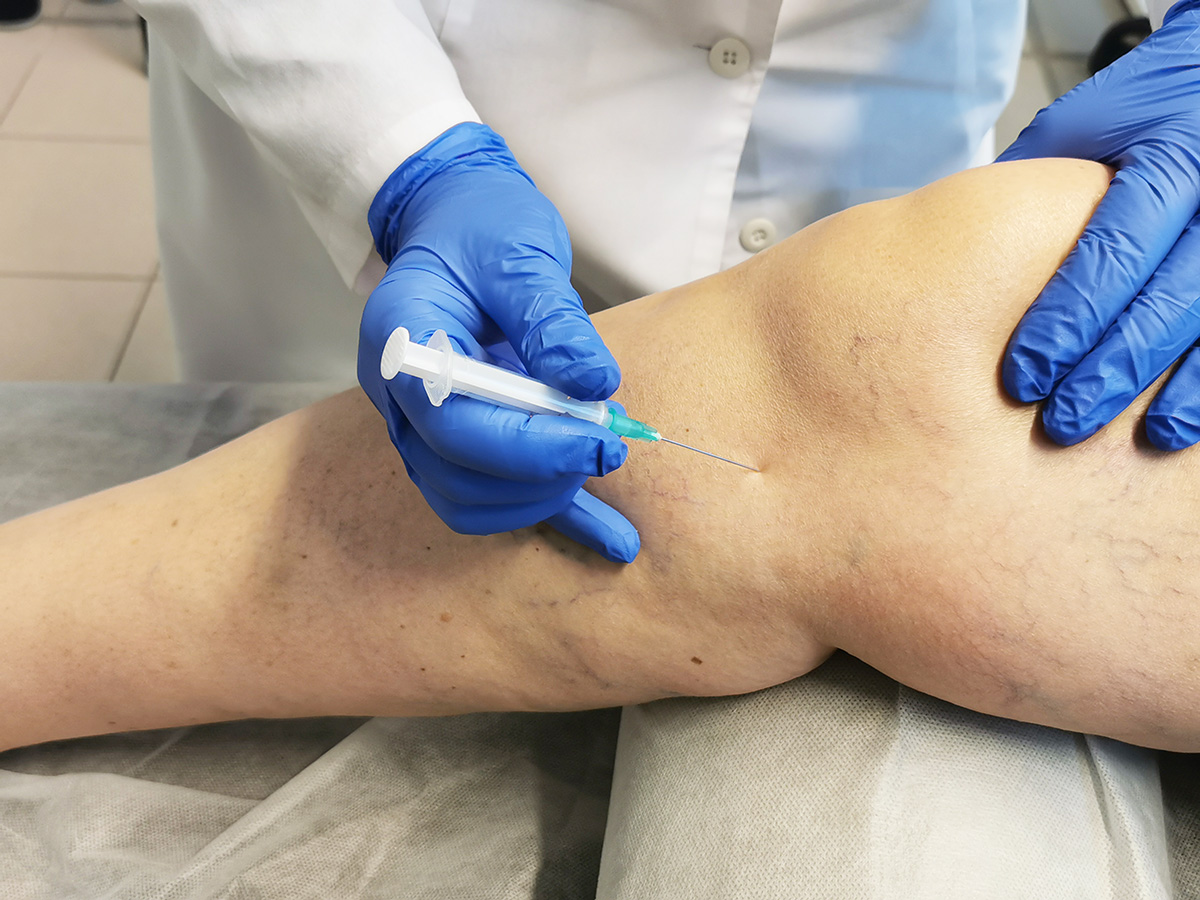 Injekcije u diprospan zgloba koljena - Analize April