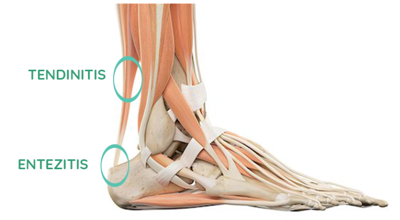 liječenje 3 stadija artroze koljena
