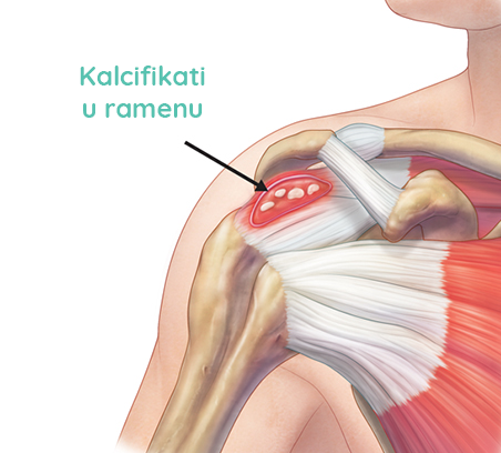 Bol u lijevom ili desnom ramenu – uzroci i liječenje | Kreni zdravo!