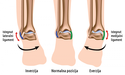 Otečene noge u gležnju – uzroci, simptomi i liječenje